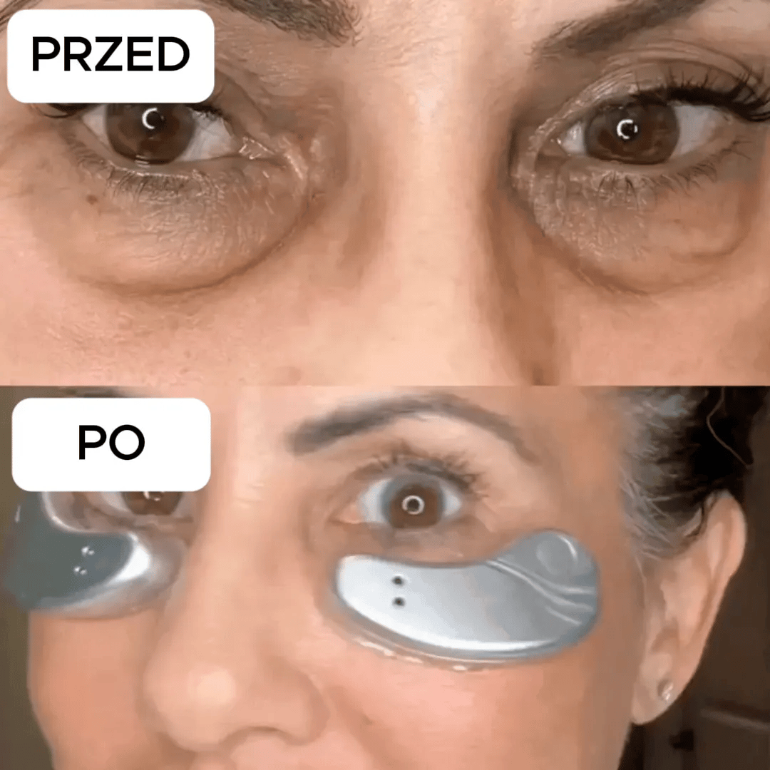Efekty stosowania solevi w okolicy oczu — przed i po